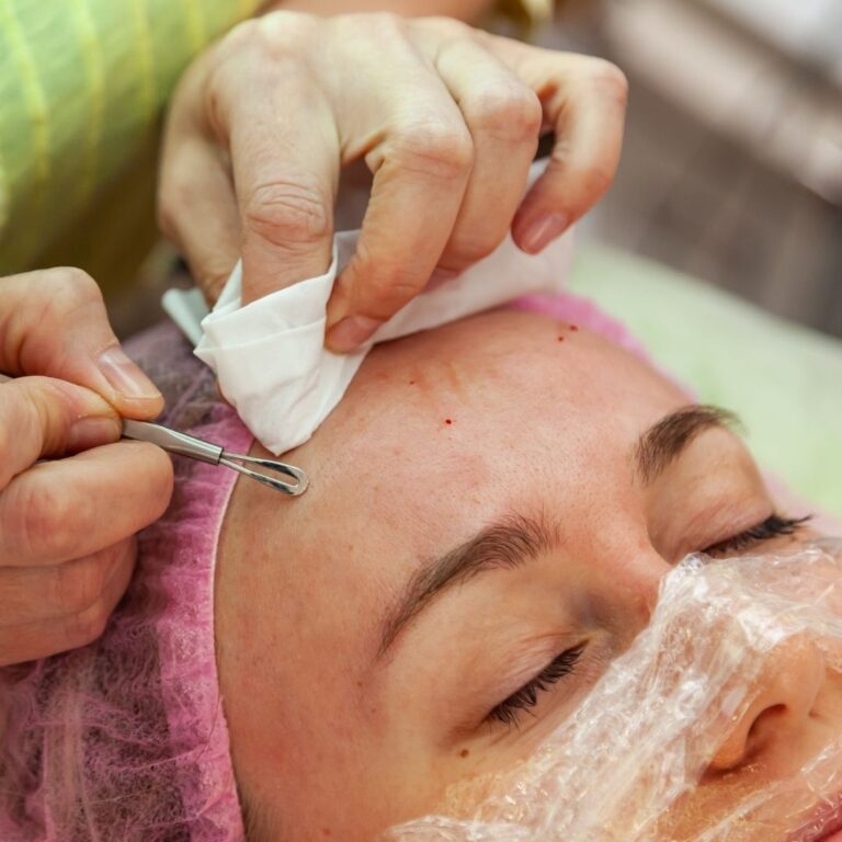 Acne Scar Treatment 